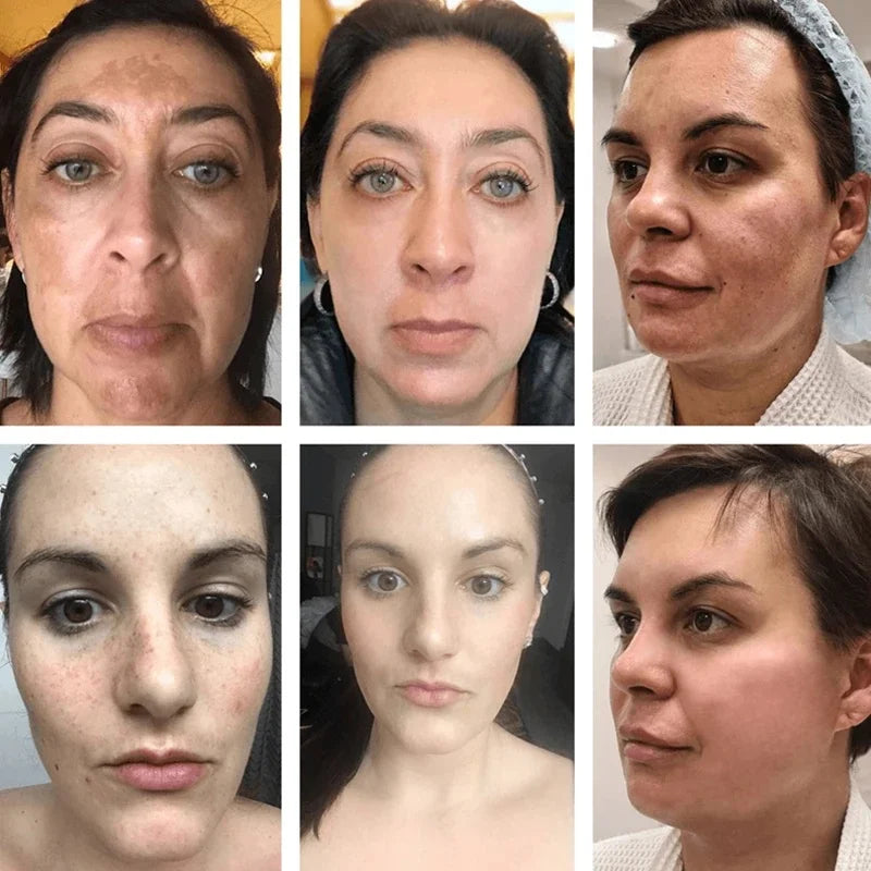 Freckle Whiten Cream Effective Removing Spot Eliminate Brown Stain Melasma Melanin Blemishes Lighten Moisturiser Face Skin Care
