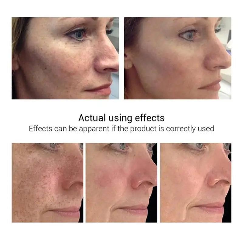 Freckle Whiten Cream Effective Removing Spot Eliminate Brown Stain Melasma Melanin Blemishes Lighten Moisturiser Face Skin Care