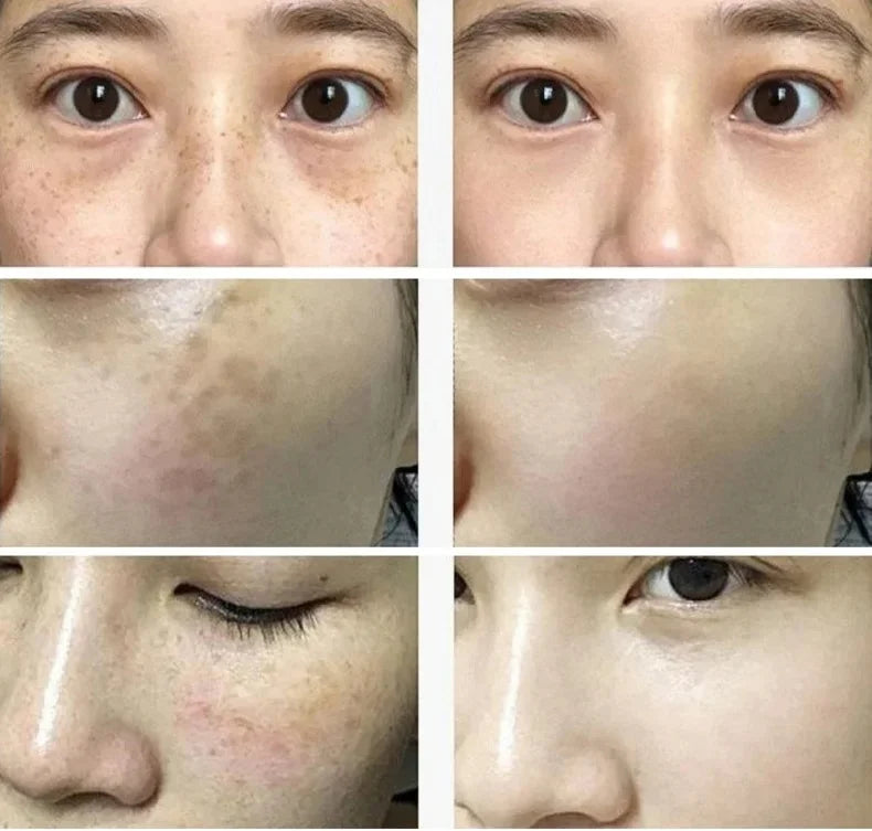 Freckle Whiten Cream Effective Removing Spot Eliminate Brown Stain Melasma Melanin Blemishes Lighten Moisturiser Face Skin Care