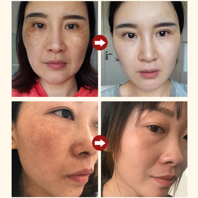 Freckle Whiten Cream Effective Removing Spot Eliminate Brown Stain Melasma Melanin Blemishes Lighten Moisturiser Face Skin Care