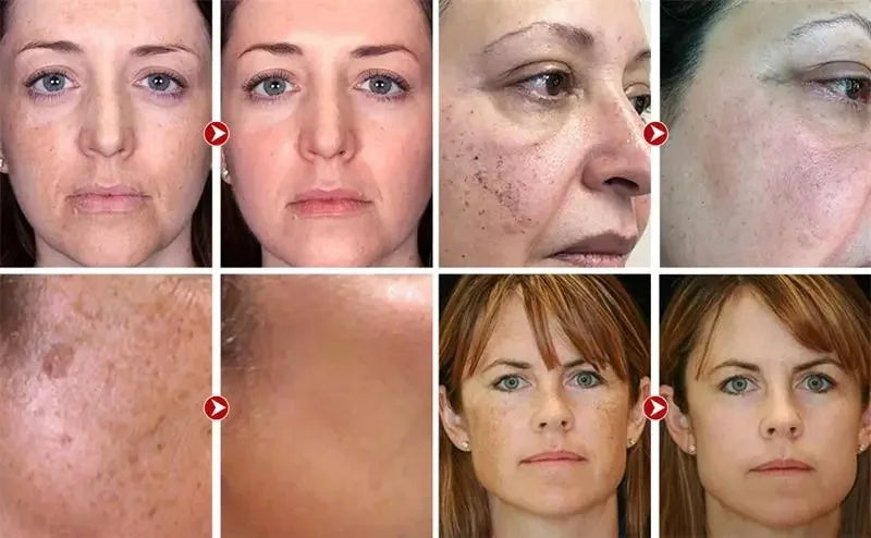 Freckle Whiten Cream Effective Removing Spot Eliminate Brown Stain Melasma Melanin Blemishes Lighten Moisturiser Face Skin Care